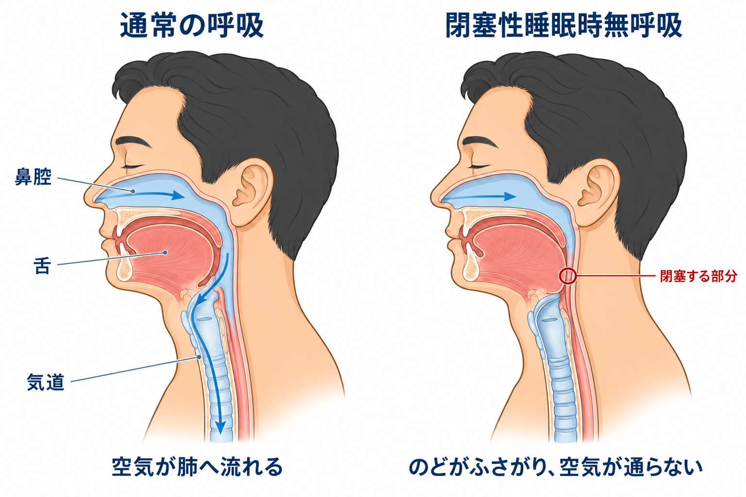 正常な呼吸と閉塞性睡眠時無呼吸の気道比較