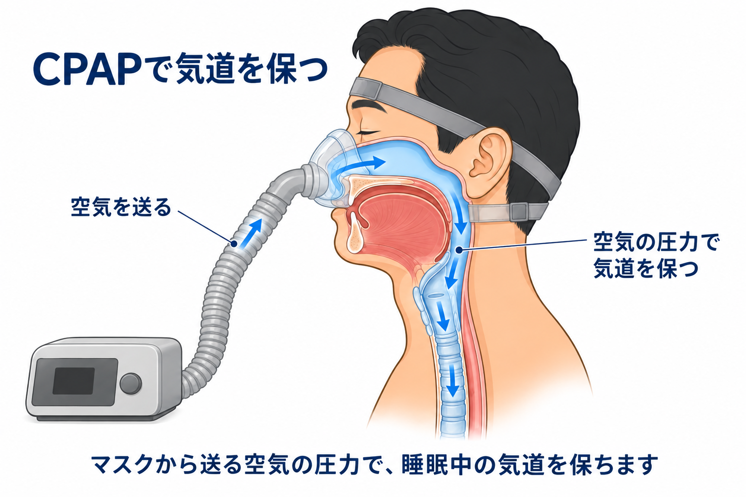CPAPが空気の圧力で気道を保つ仕組み